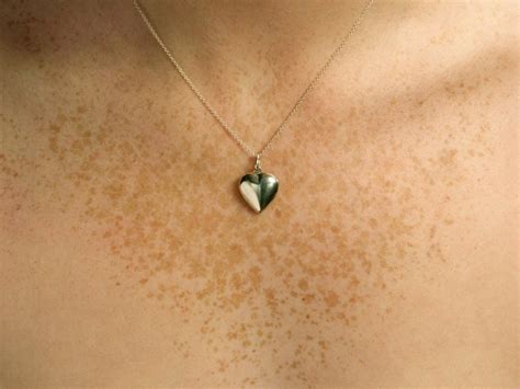 freckles boobs|Breast cancer symptoms: What chest freckles can mean